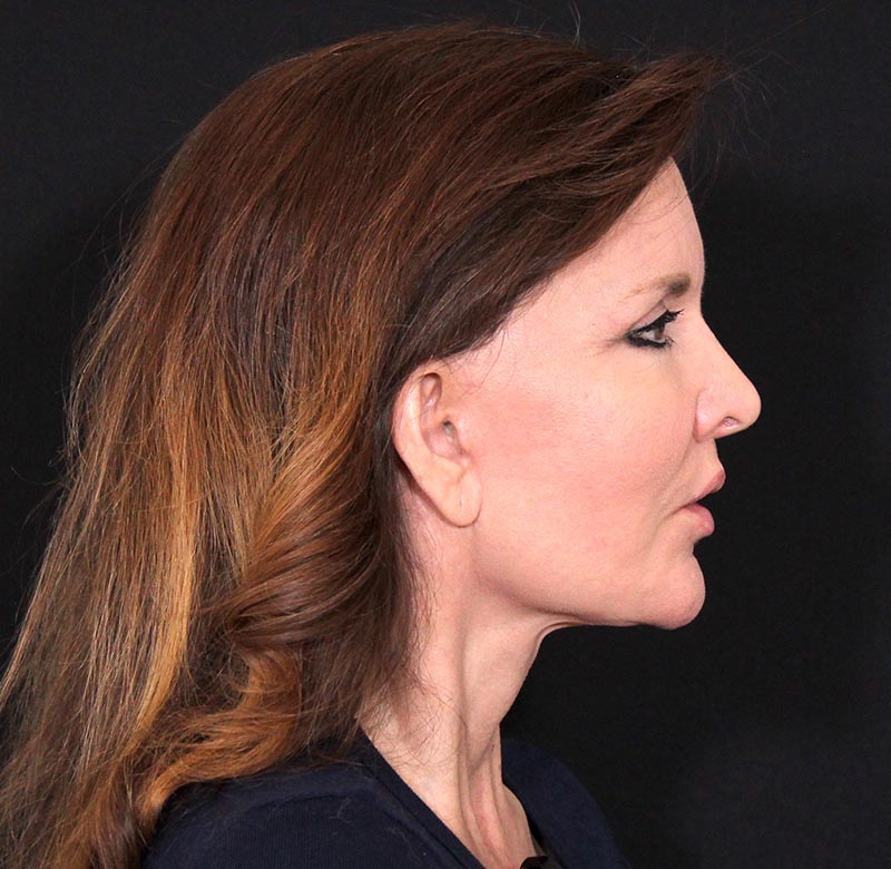 Mid Facelift Before & After Image
