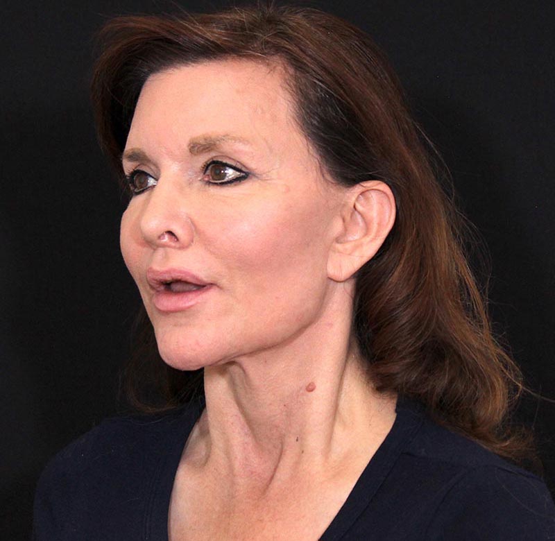 Mid Facelift Before & After Image