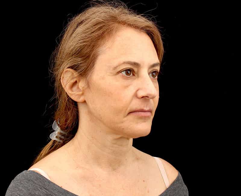 Mid Facelift Before & After Photo
