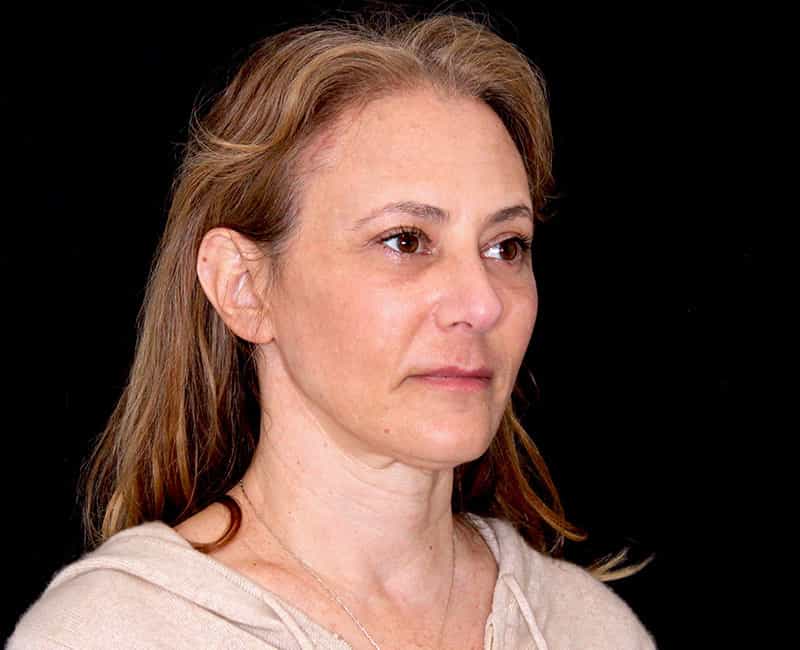 Mid Facelift Before & After Photo