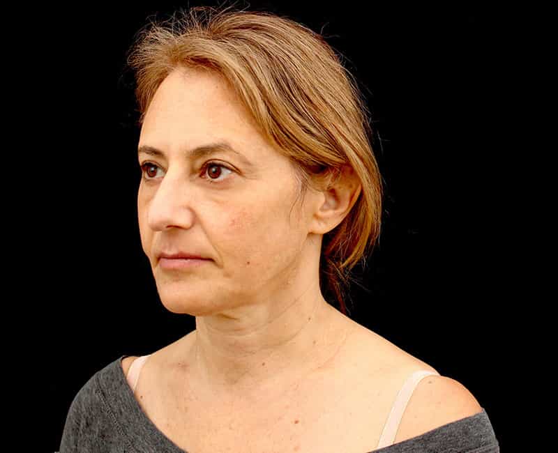 Mid Facelift Before & After Image