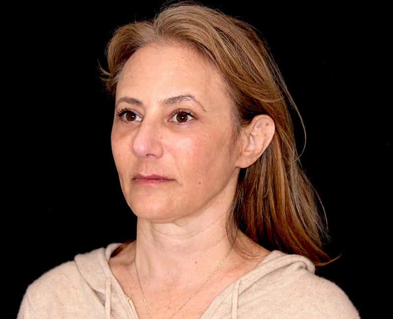 Mid Facelift Before & After Image