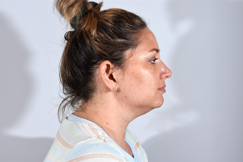 Neck Contouring Before & After Photo