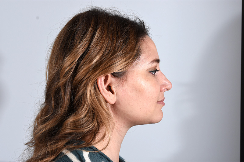 Neck Contouring Before & After Photo