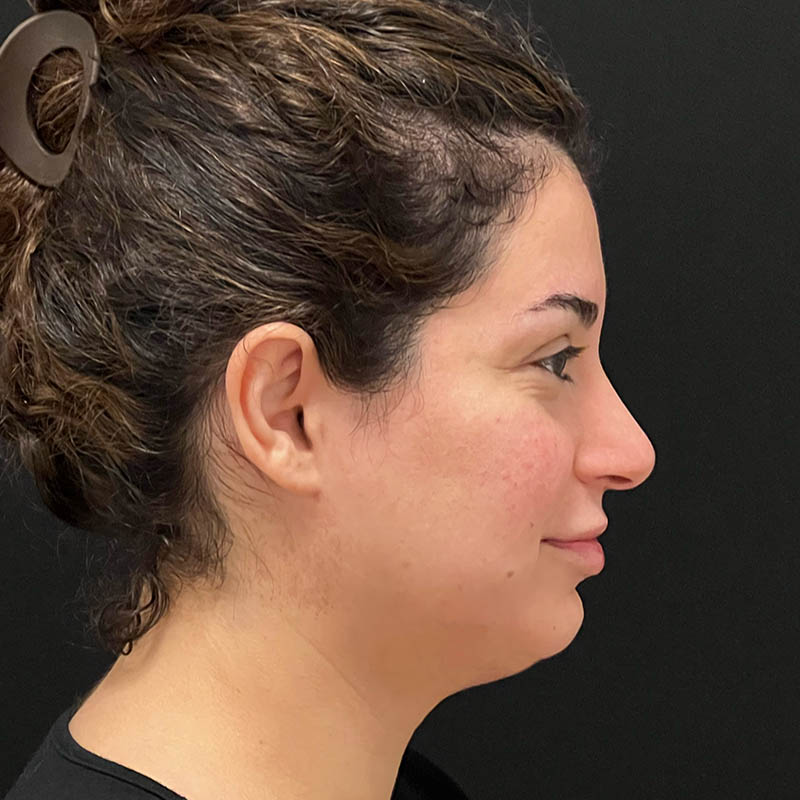 Neck Contouring Before & After Photo