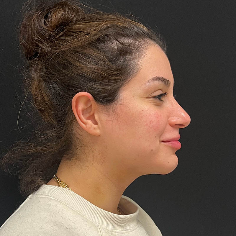 Neck Contouring Before & After Photo
