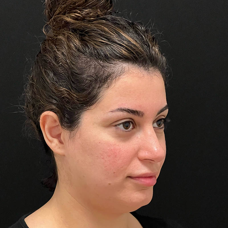 Neck Contouring Before & After Image