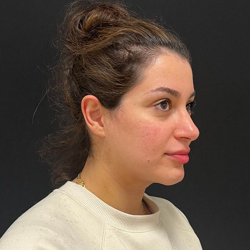 Neck Contouring Before & After Image