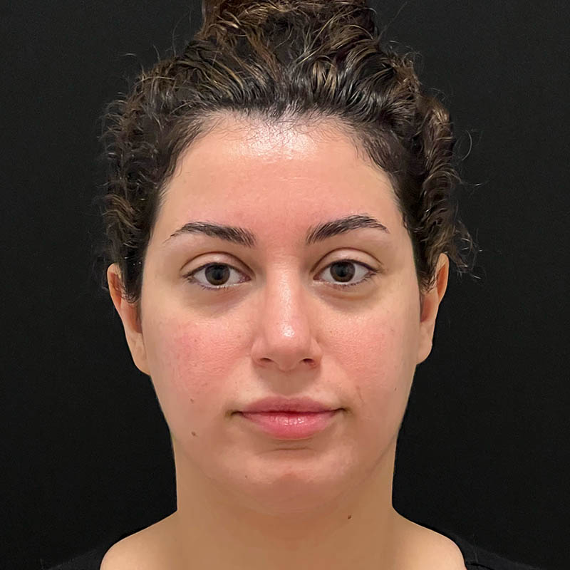 Neck Contouring Before & After Image