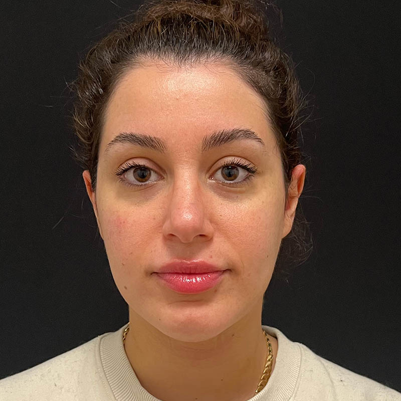 Neck Contouring Before & After Image