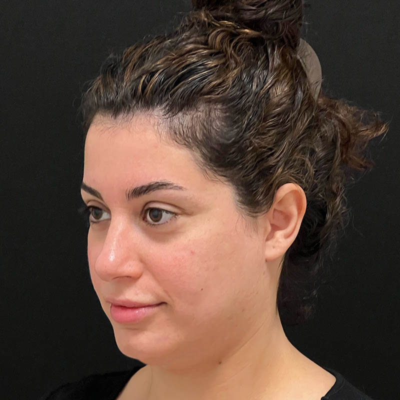 Neck Contouring Before & After Image