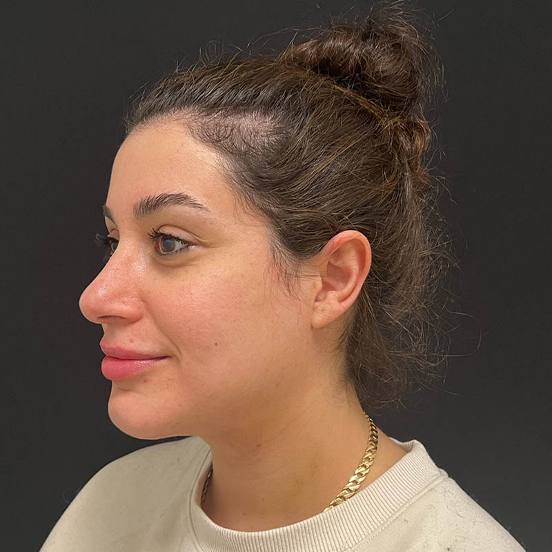 Neck Contouring Before & After Image