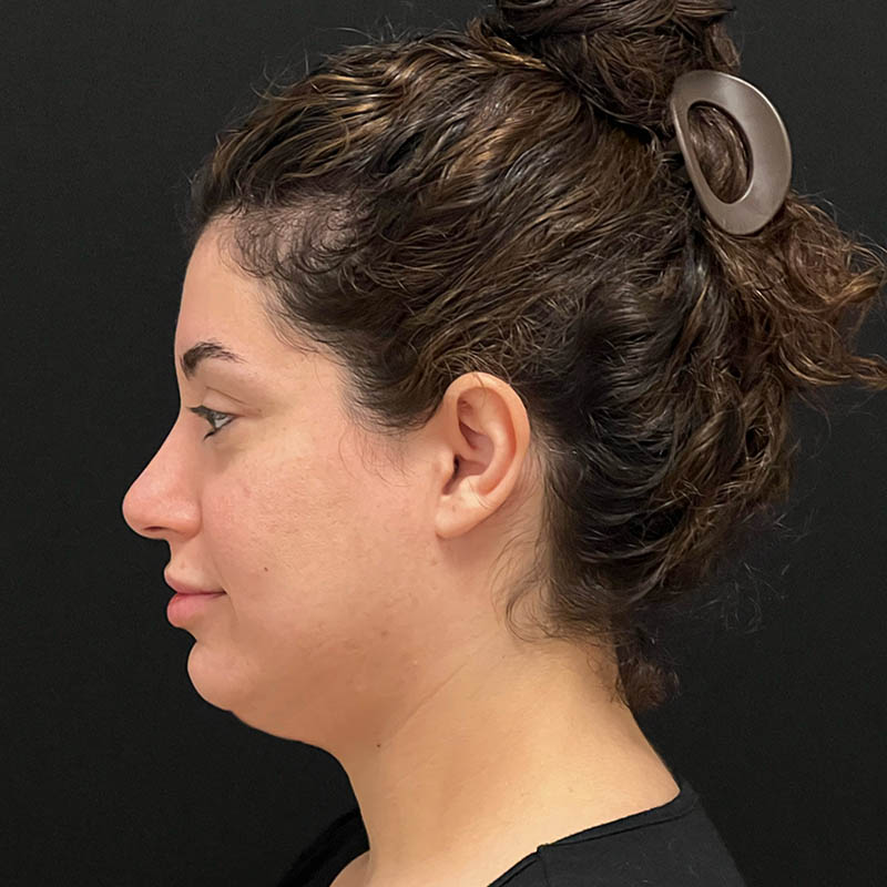 Neck Contouring Before & After Image