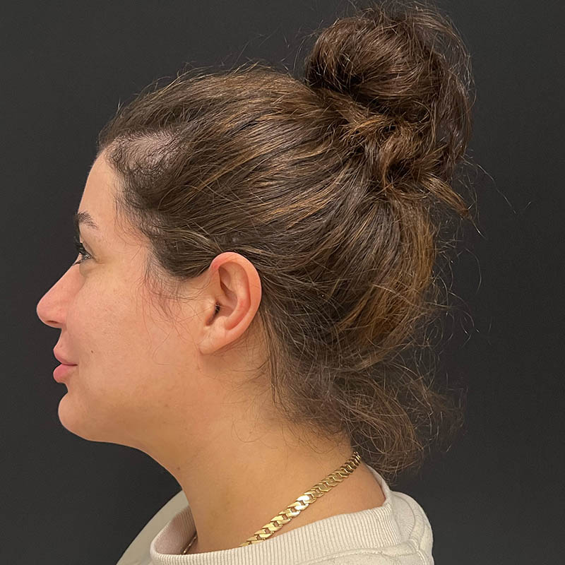 Neck Contouring Before & After Image
