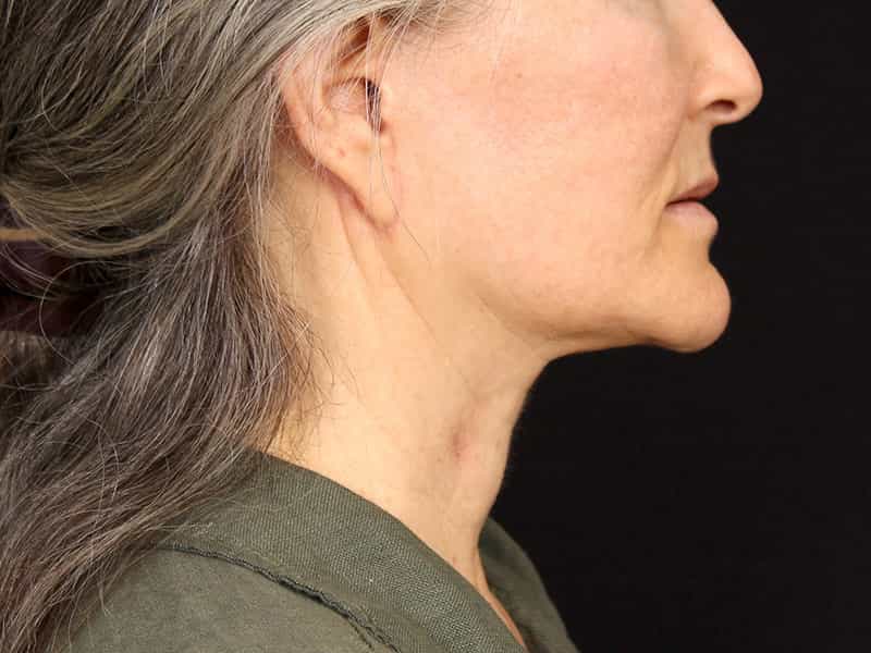 Neck Contouring Before & After Image