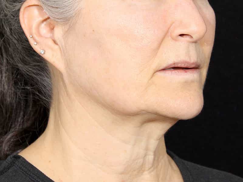 Neck Contouring Before & After Image