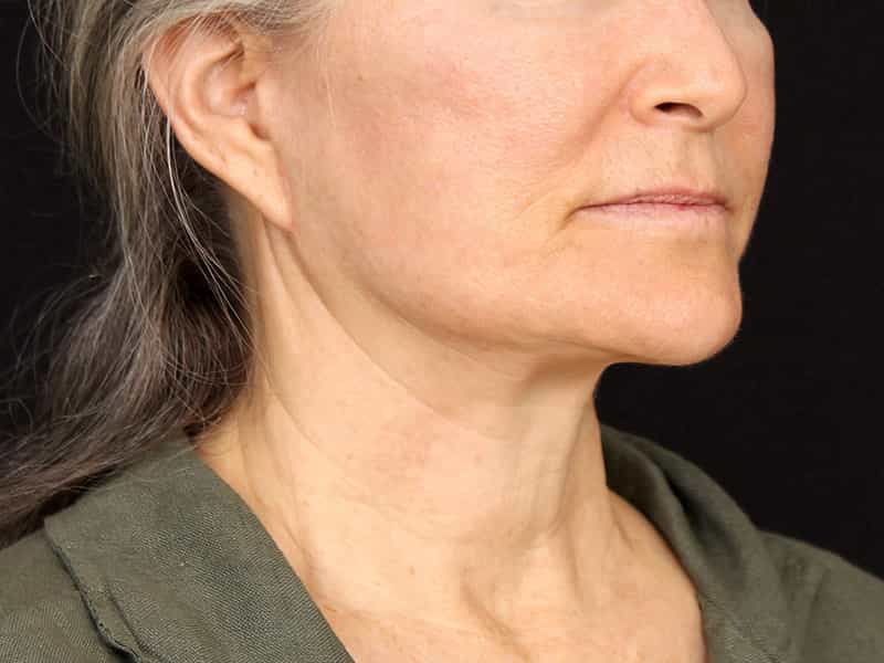 Neck Contouring Before & After Image