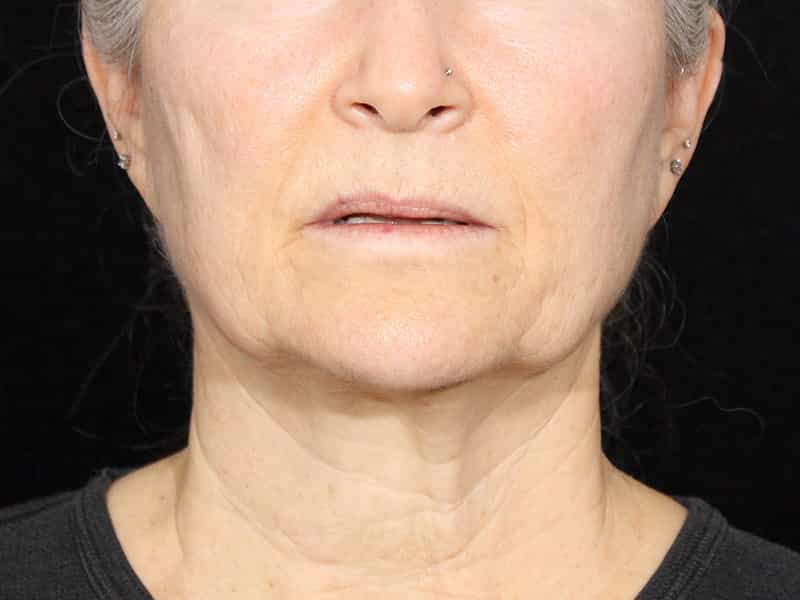 Neck Contouring Before & After Image