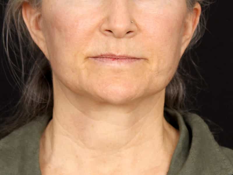 Neck Contouring Before & After Image