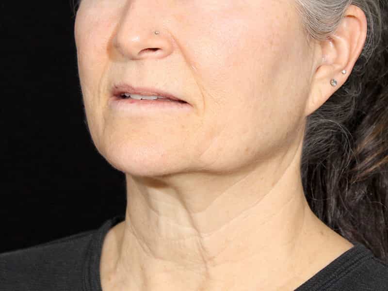 Neck Contouring Before & After Image