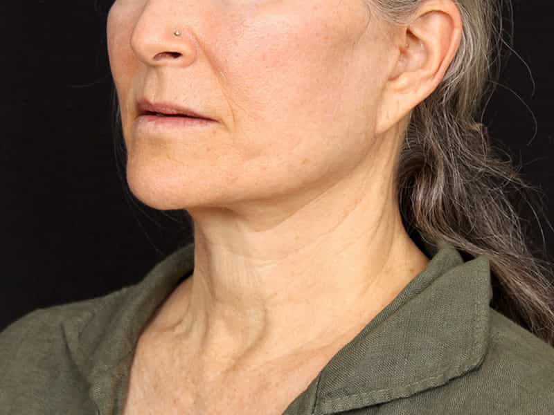 Neck Contouring Before & After Image