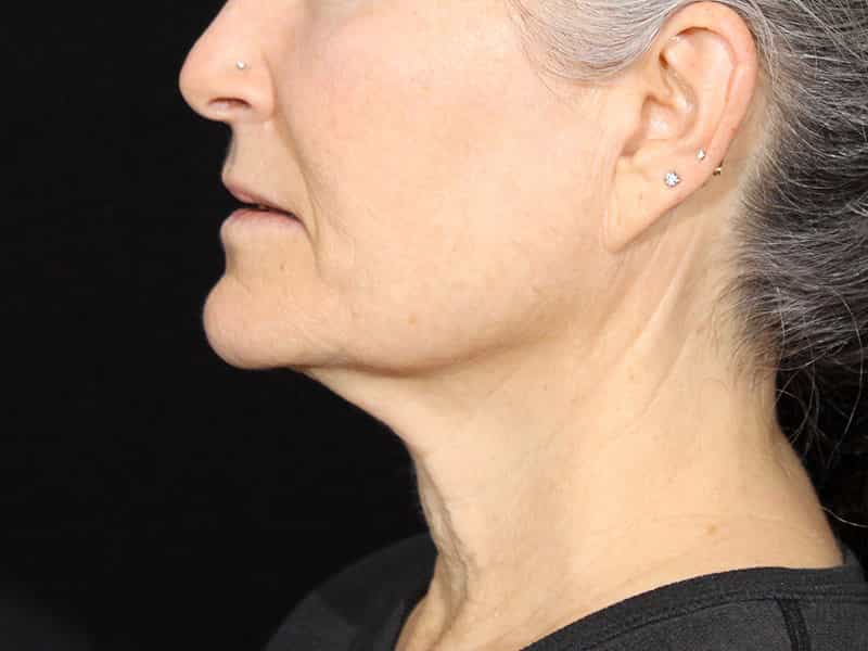 Neck Contouring Before & After Image