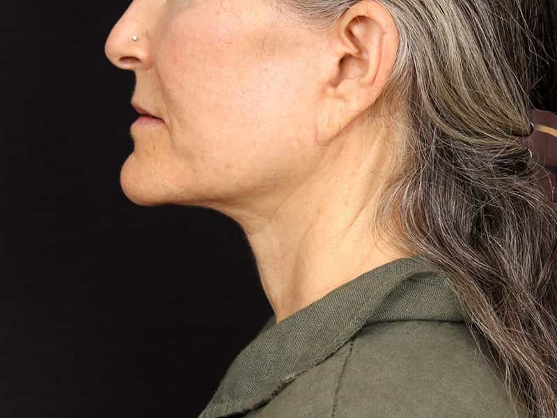 Neck Contouring Before & After Image