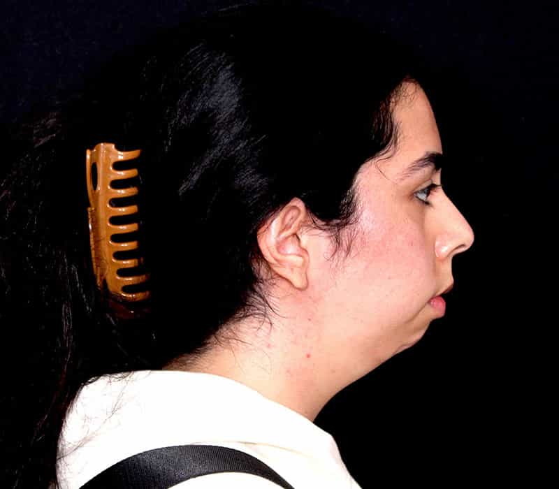 Neck Contouring Before & After Photo