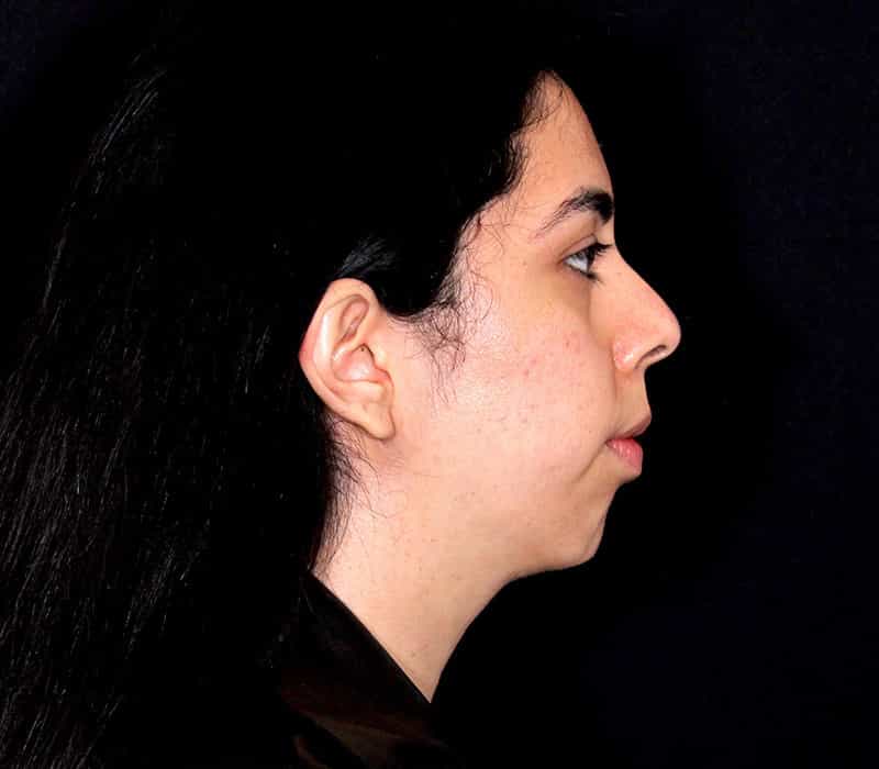 Neck Contouring Before & After Photo