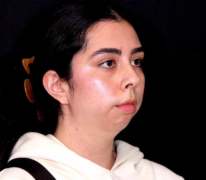 Neck Contouring Before & After Image