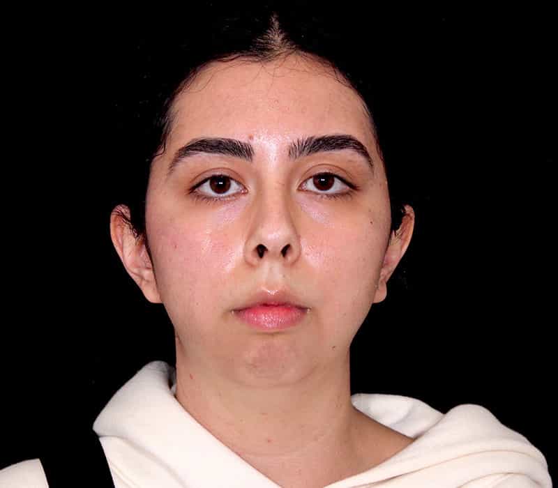 Neck Contouring Before & After Image