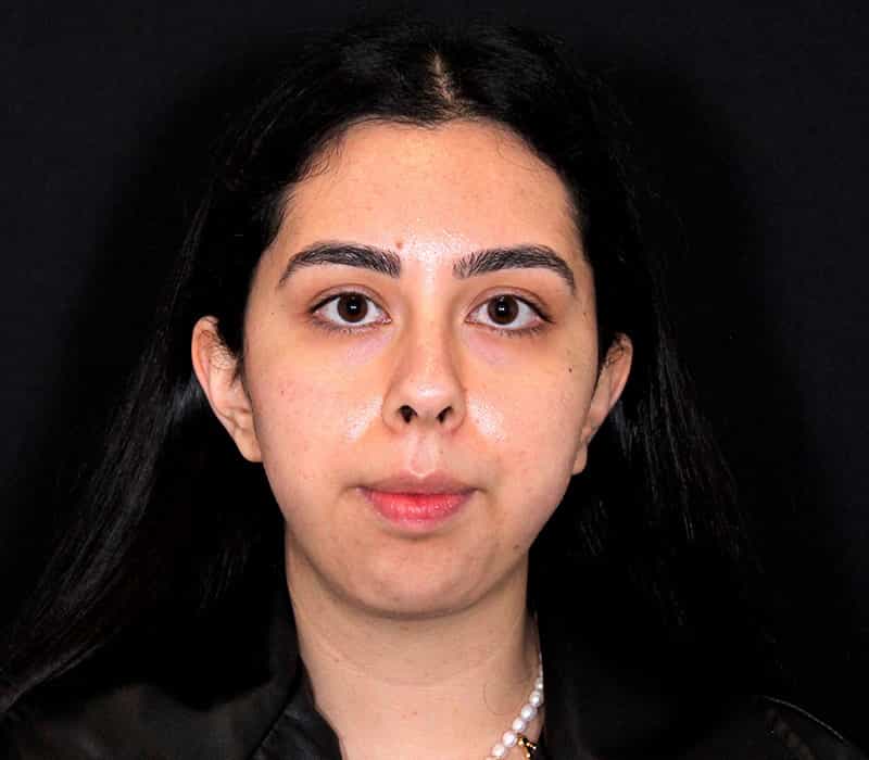 Neck Contouring Before & After Image