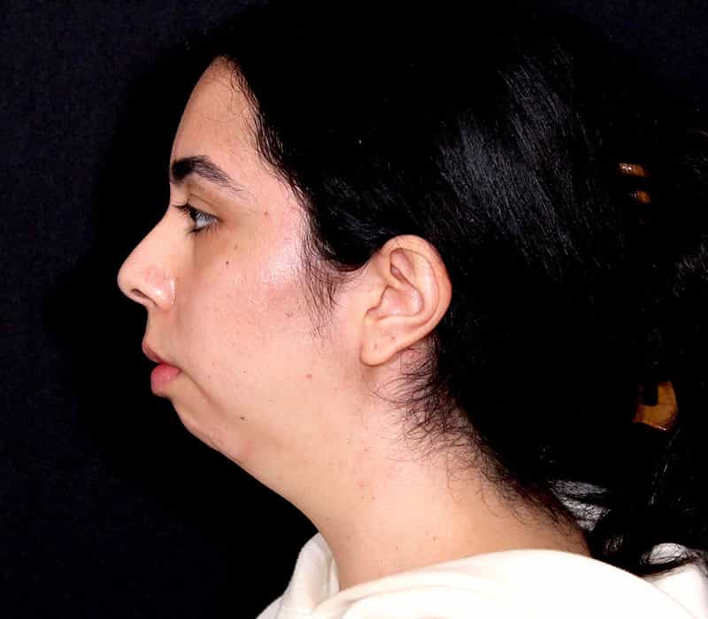 Neck Contouring Before & After Image