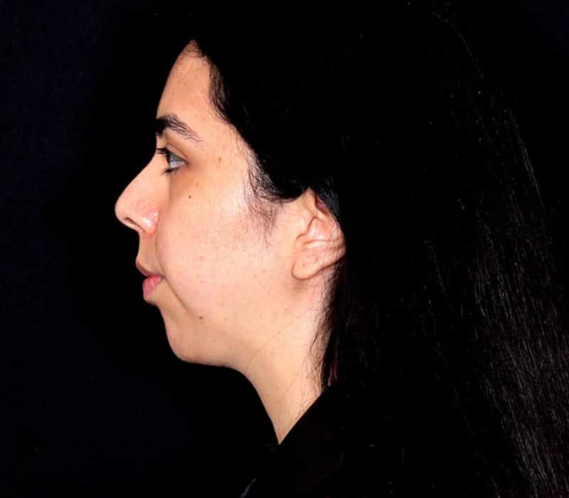 Neck Contouring Before & After Image
