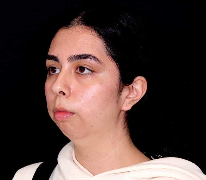 Neck Contouring Before & After Image