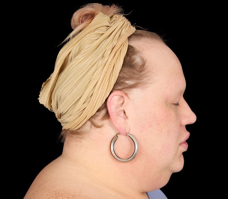 Neck Contouring Before & After Photo