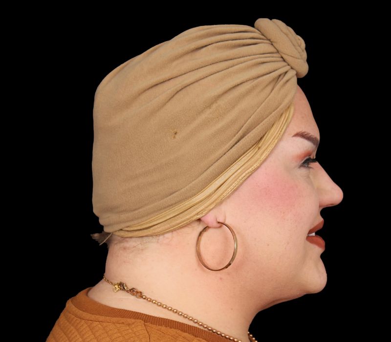 Neck Contouring Before & After Photo