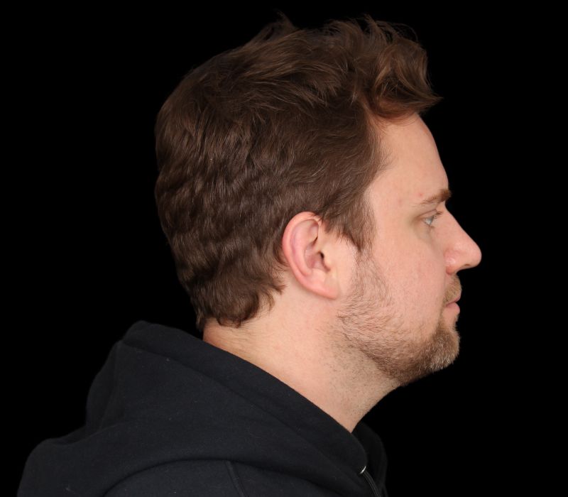 Neck Contouring Before & After Photo