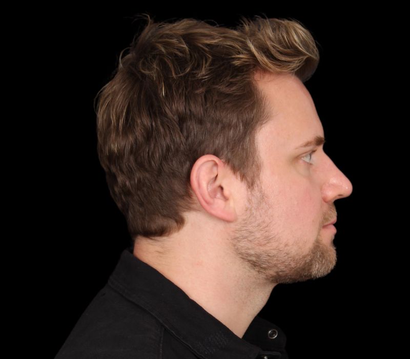 Neck Contouring Before & After Photo