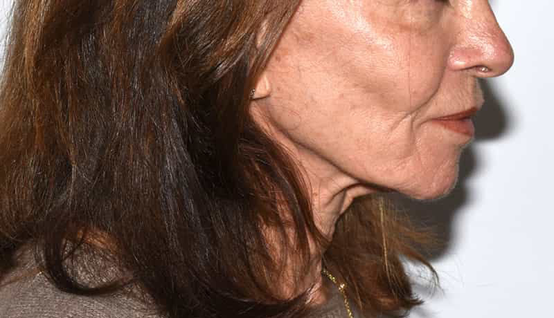 Necklift Before & After Photo