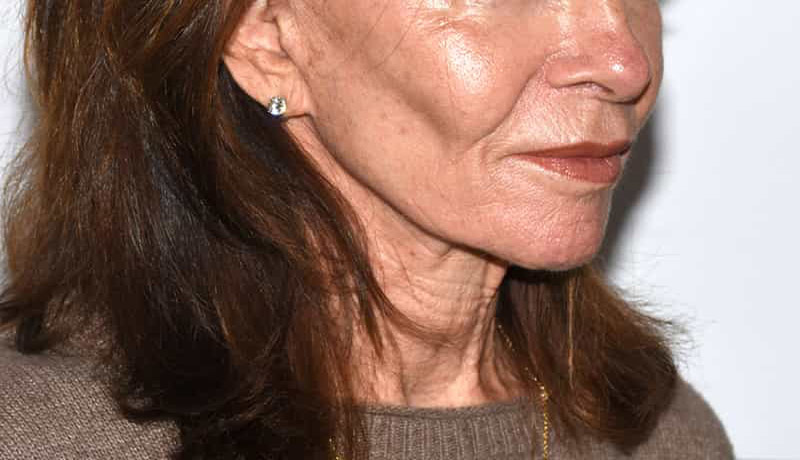 Necklift Before & After Image