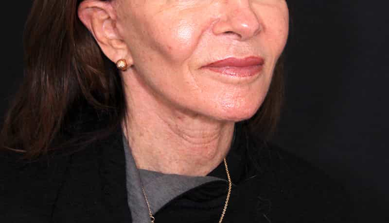 Necklift Before & After Image
