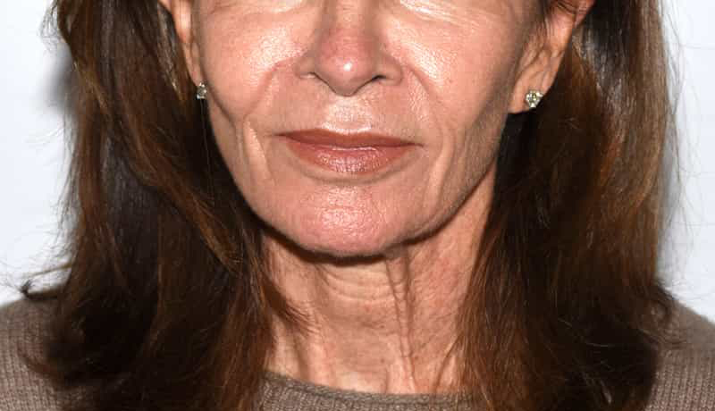 Necklift Before & After Image