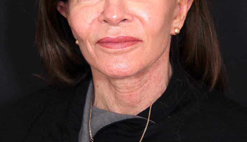 Necklift Before & After Image