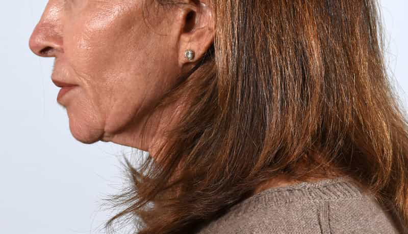 Necklift Before & After Image