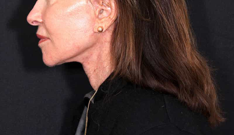 Necklift Before & After Image