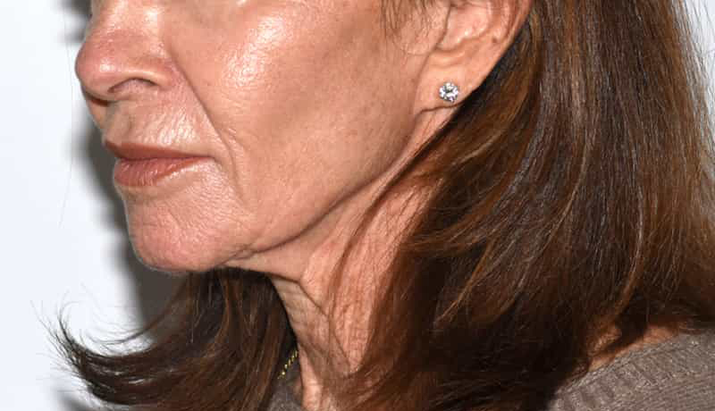 Necklift Before & After Image