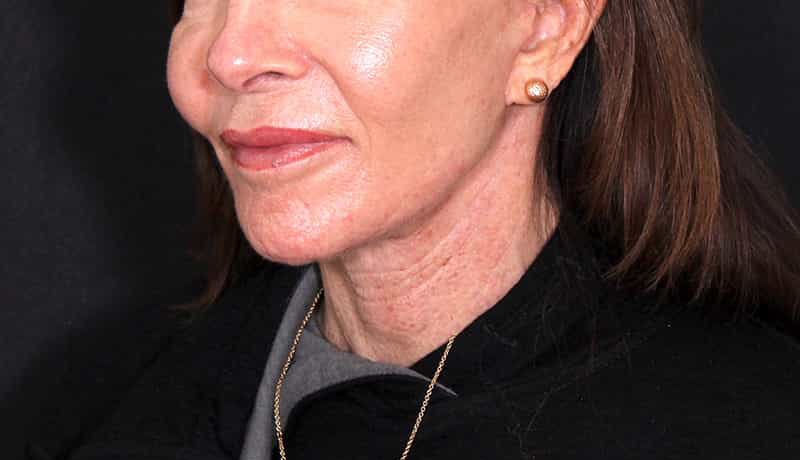 Necklift Before & After Image