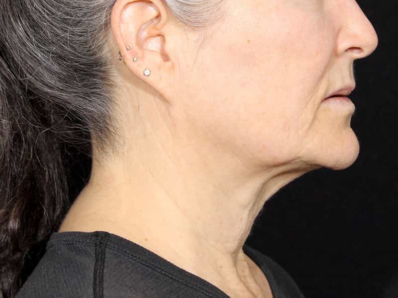 Necklift Before & After Photo