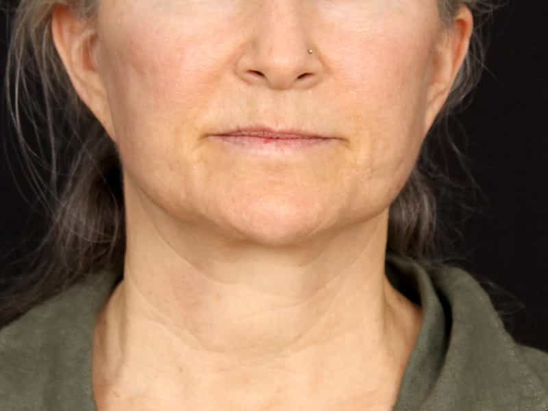 Necklift Before & After Image